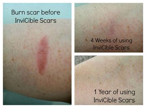 1 year later using @inviciblescars on my burn scar and it is virtually undetectable! via ...