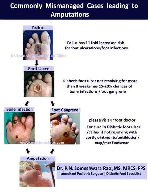 Diabetic Foot Ulcer Stages 2nd MTP Region Podiatry Doctor | atelier-yuwa.ciao.jp