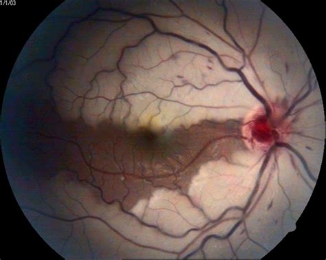 Central Retinal Artery Occlusion : Central Retinal Vein Occlusion ...