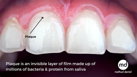 Gray between front teeth calculus - retrotery