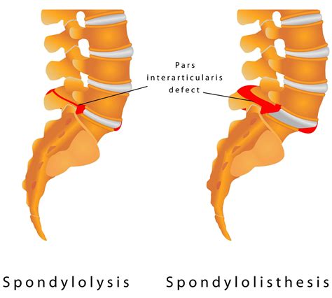 A Spotlight on Spondylolisthesis From Houston Spine & Rehab