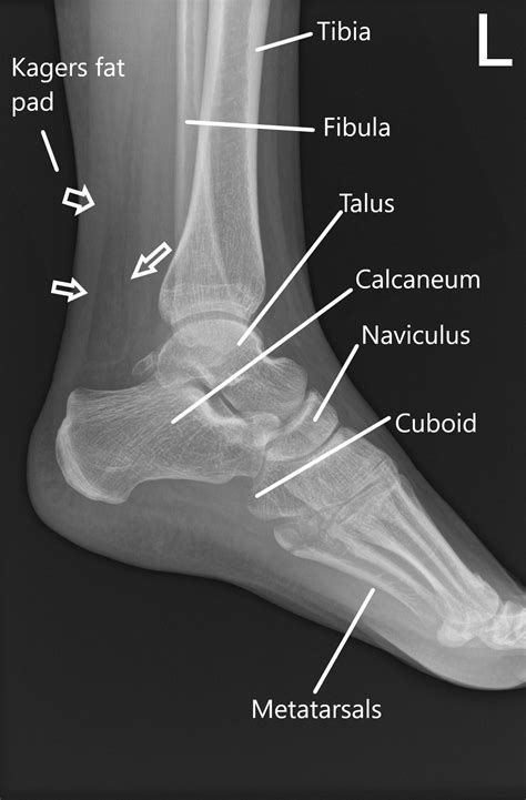 Achilles Tendon Injuries | Complete Orthopedics | Multiple NY Locations