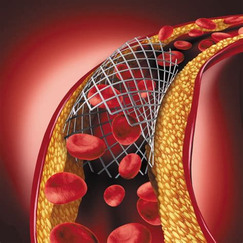 What happens if my stent stops working? - Harvard Health