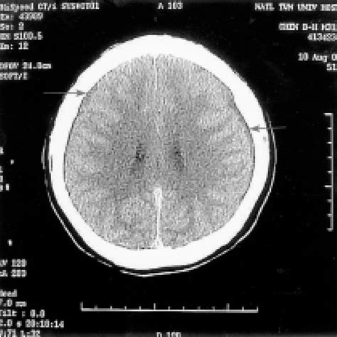 Posterior images of 99m Tc-DTPA radionuclide cisternogram obtained at... | Download Scientific ...