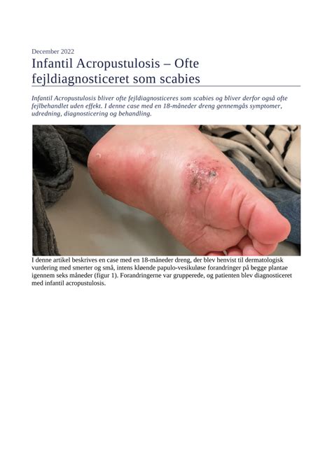 (PDF) Infantil Acropustulosis – Ofte fejldiagnosticeret som scabies