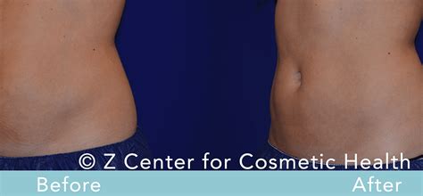 Coolsculpting Abdomen Before & After #7 - Zcosmetic Health