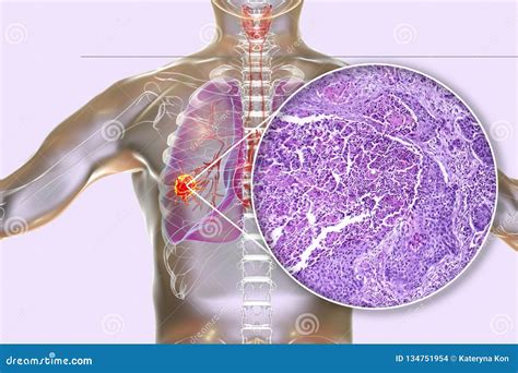 Lung Cancer, Illustration and Photo Under Microscope Stock Illustration - Illustration of ...