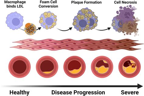 Atherosclerosis begins with the recognition of low-density lipoprotein ...