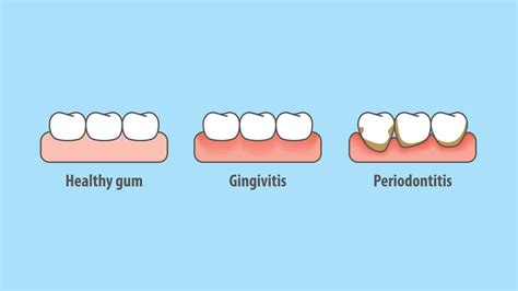 Get Back To Your Healthy Gums- Tips & Tricks - Adkins Family Dentistry