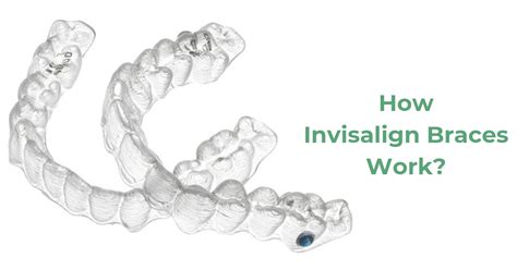 How Invisalign Braces Work? - Teeth & Braces Clinic - Indore