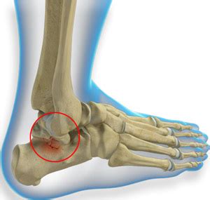 Talus Fracture Treatment Edinburg | Broken Talus McAllen | Mission