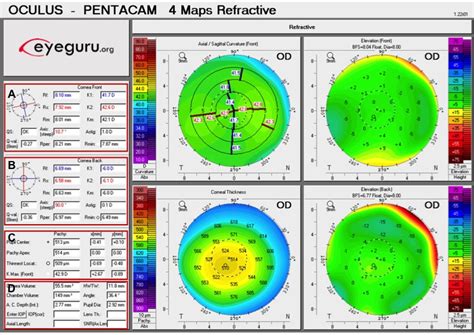 Cum se interpretează topografia corneei: 5 utilizări clinice-EyeGuru | Tech Blog