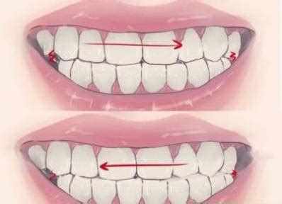 How to Stop Clenching Teeth at Night | UtoDent.com