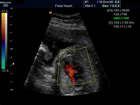 Fetal heart, color doppler, echogramm №387