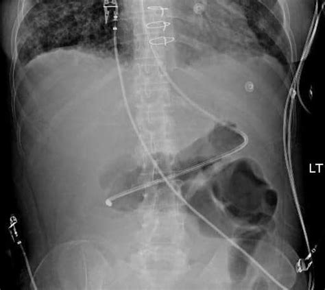 Placing Post-Pyloric Feeding Tubes | RK.MD