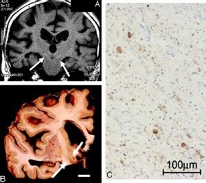 Corticobasal Degeneration - Causes, Symptoms, Treatment, Prognosis