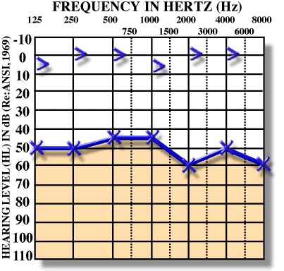 audiogram of conductive hearing loss | Speech therapy resources, Auditory verbal therapy, Speech ...