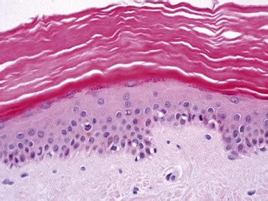 Ichthyosis Vulgaris Histology