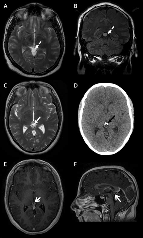 Colloid Cyst Prognosis