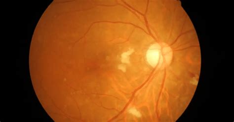 Understanding Optic Nerve Inflammation: Causes, Symptoms, and Treatment