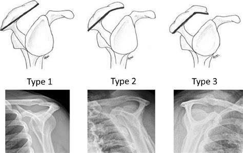 Bigliani ' s classification of acromion undersurface with corresponding ...