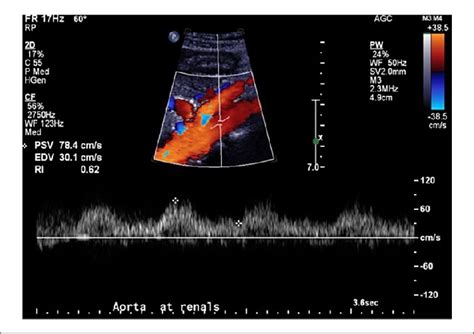 Case 1. Abnormal parvus tardus Doppler spectral waveform from the aorta... | Download Scientific ...