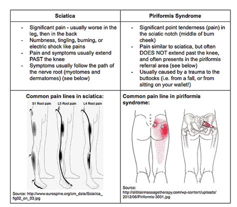 Symptoms Of Sciatica Buttock