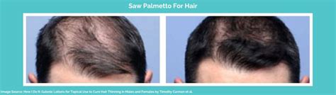 Saw Palmetto For Hair Loss: How It Works & Usage | Longevita