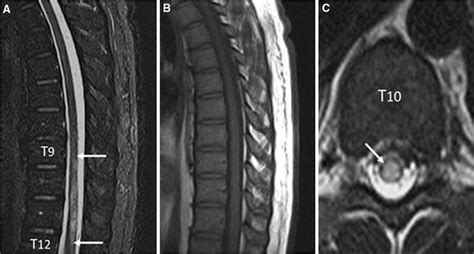 Acute transverse myelitis. Spine MRI of a 22-year-old Iranian male with... | Download Scientific ...