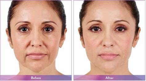 Juvederm Range, Botox, Dermal Fillers - Richmond cosmetic clinic