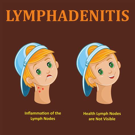 Rash And Swollen Lymph Nodes Causes Photos And Treatment