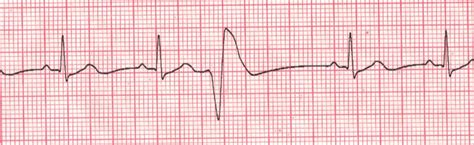 Cardiac Arrhythmia: Premature Ventricular Contractions (PVC) - When The ...