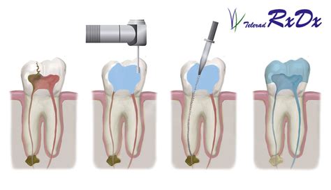 Root Canal Therapy? - Know Before You Go - RxDx Healthcare