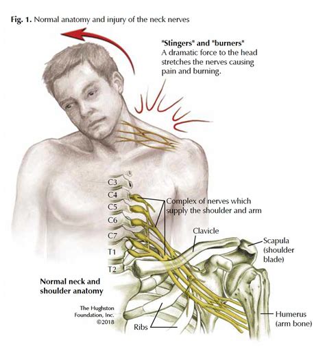 Brachial Plexus: Traumatic Nerve Injuries - Hughston Clinic