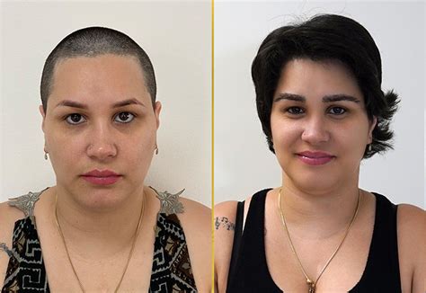 Female Hair Transplant in Miami | Care4Hair