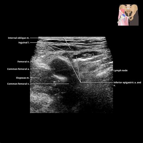 Pecten Pubis Conjoint Tendon