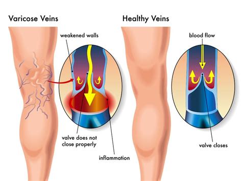 Varicose Veins - McQuaid Vein Care