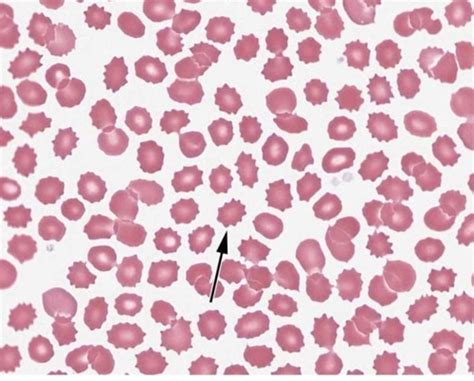 Echinocytes (aka burr cells) in a peripheral blood smear. Note the uniform distribution of ...