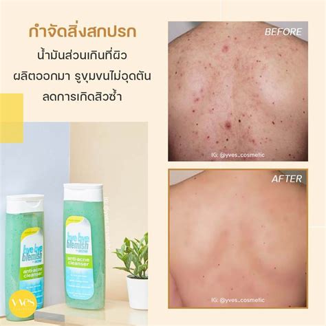 bye bye blemish Anti-Acne Cleanser | Yvescosmetic