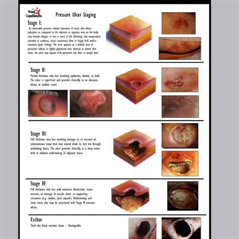 Wound stages | Pressure ulcer staging, Nursing study, Pressure ulcer