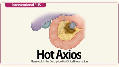 Hot Axios Deployment / Endoscopic Necrosectomy / Stent Removal - YouTube