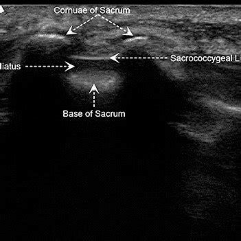 Transverse sonographic view of the sacral hiatus. The two sacral... | Download Scientific Diagram