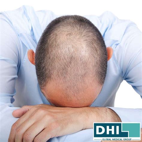 Going Bald Too Young? Top Tips From The Hair Loss Experts! - DHI Global