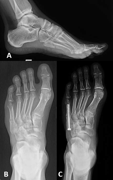 X-ray of the fifth metatarsal fracture in left foot in an elite soccer ...