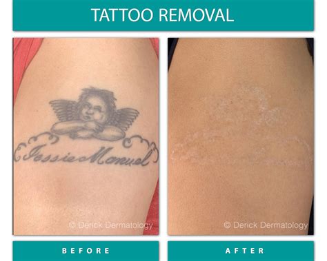 Before & After Gallery - Tattoo Removal - Derick Dermatology