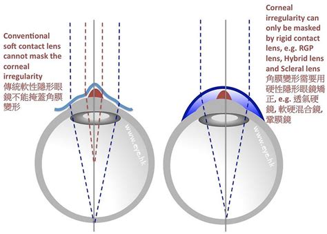 How to select contact lenses for Keratoconus ? | Hong Kong | EYE.hk