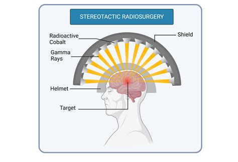 Stereotactic Radiosurgery Procedure With Radiation Beams | BioRender Science Templates