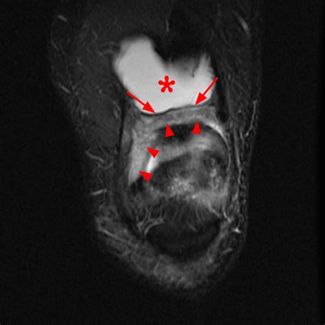 Synovial Plicae of the Knee | Radsource