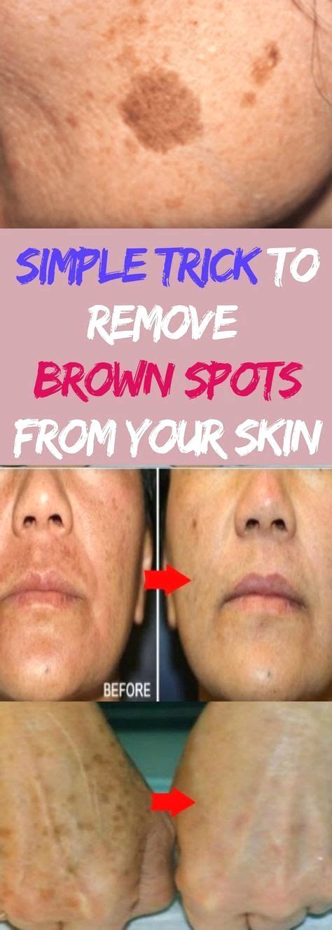 SIMPLE TRICK TO REMOVE BROWN SPOTS FROM YOUR SKIN in 2020 | Spots on face, Brown age spots ...