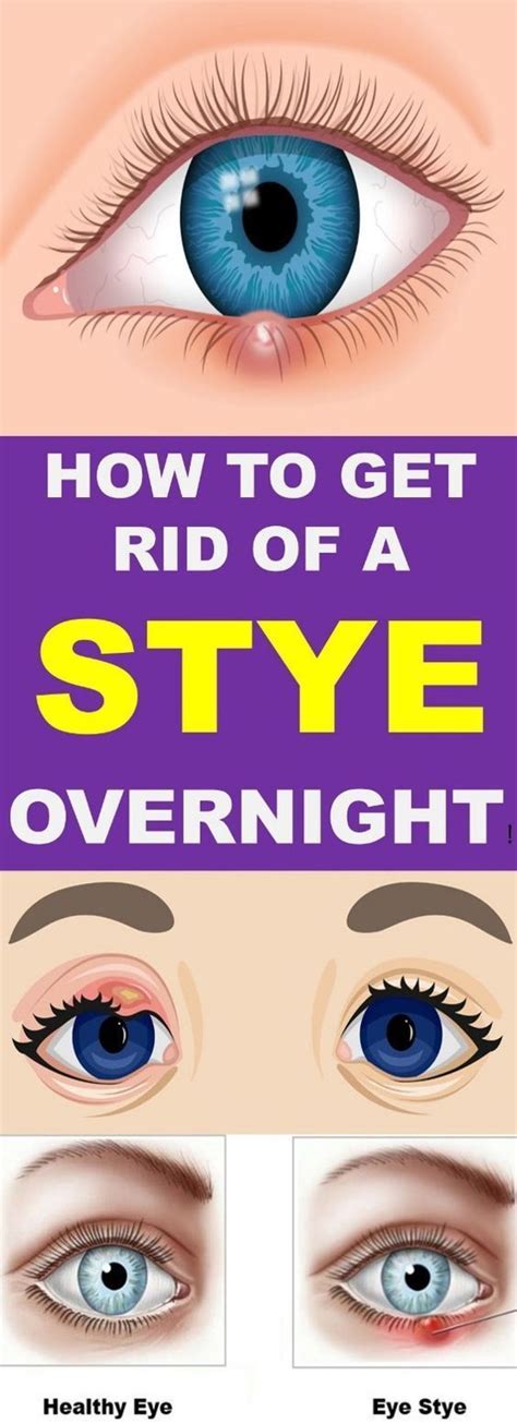 How To Get Rid Of A Stye Overnight - Kok Vannak | Stye, Eye stye remedies, Stye treatment